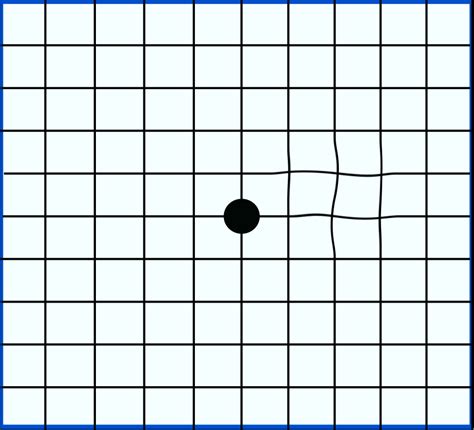 An Amsler grid showing mild distortion. | Grid system, Low vision, Eye test