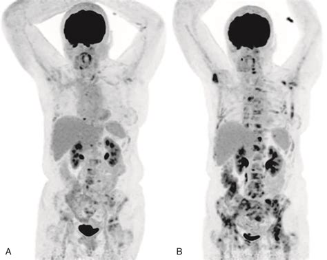 The Breast Cancer Survivor: Breast Cancer Metastasis To Spine