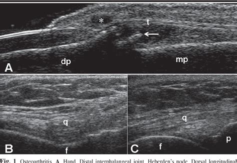 Ultrasound imaging for the rheumatologist VIII. Ultrasound imaging in osteoarthritis. | Semantic ...