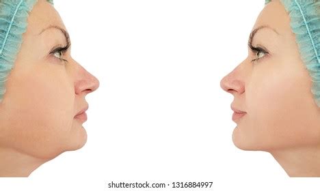 Woman Chin Lift Before After Procedures Stock Photo 1316884997 | Shutterstock