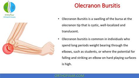 Olecranon Bursitis (or Student Elbow) is a swelling of the bursa at the ...