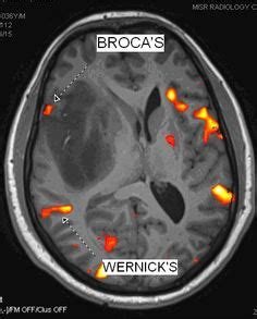 13 Best Broca's area images in 2019 | Broca's area, Brain, Neurology