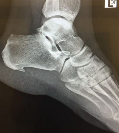 How do I fix my Heel Spur? - San Diego Running & Sports Injury Clinic