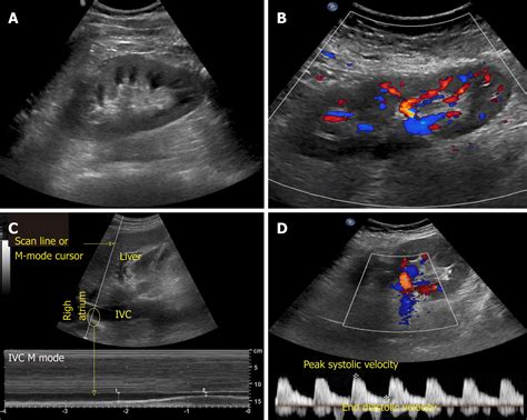 Kidney Ultrasound Labeled