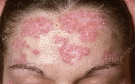 Lupus erythematosus - Stock Image - C050/0881 - Science Photo Library