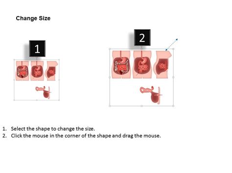 0914 Kock Pouch Colon Surgery Medical Images For PowerPoint | PowerPoint Slide Images | PPT ...