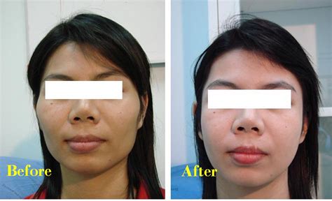 Before And After Photos Of Plastic Surgery Thailand: Cheek Bone ...