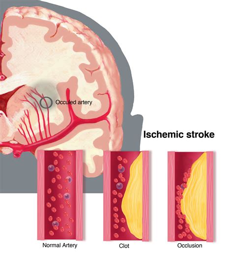 Ischemic Stroke | Compel Visuals