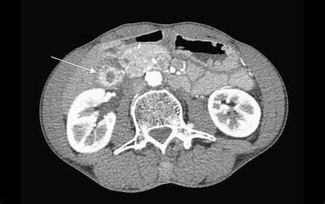 Gallbladder Adenomyomatosis Presenting With Abdominal Pain | Cureus