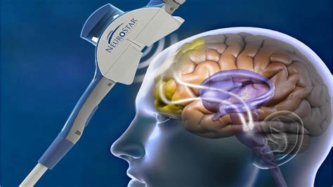 How NeuroStar TMS Therapy Works - Tranquility TMS Center