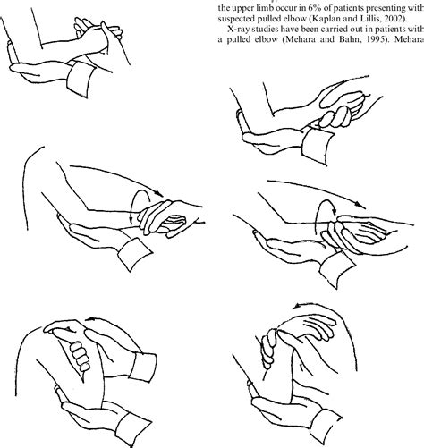 [PDF] The pulled elbow: a review article | Semantic Scholar