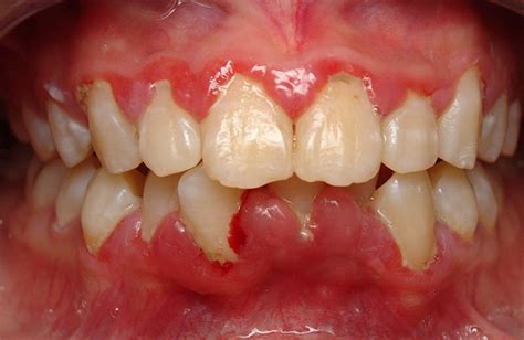 Gum Infection Symptoms – What they Are and What to Do – Dentist Says