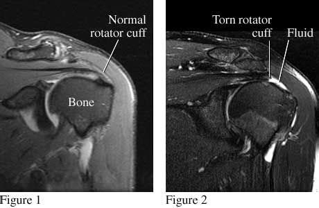 What Is a Rotator Cuff Tear? | Rotator cuff, Rotator cuff tear, Mri