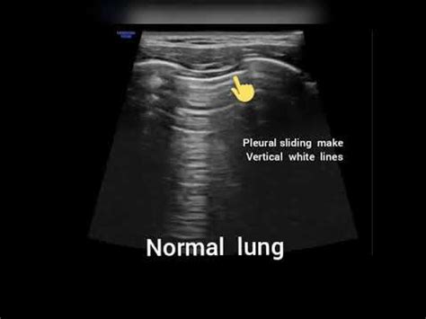 Pneumothorax ultrasound - YouTube