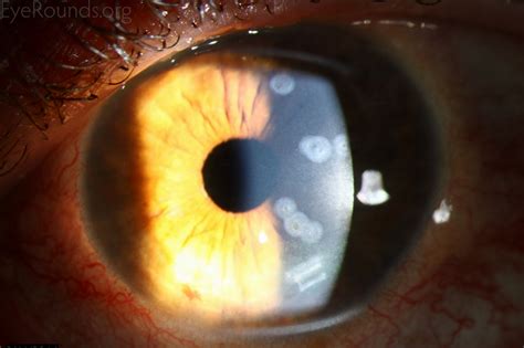 Conductive keratoplasty (CK) scars