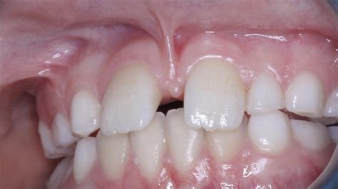 Labial Frenectomy Before And After