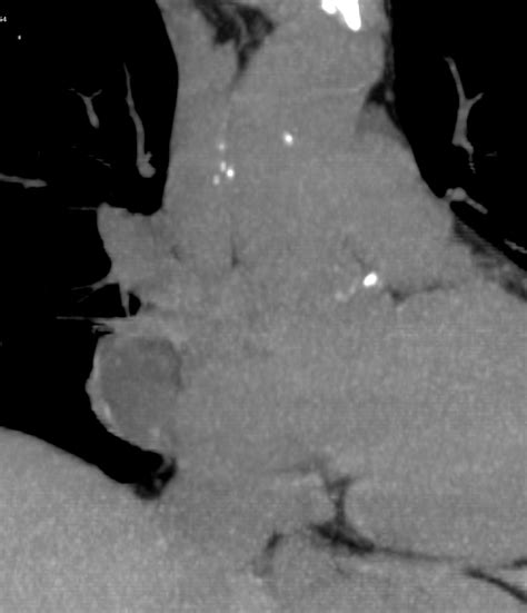 Pericardial Cyst | Heart