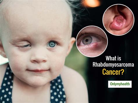 All About Rhabdomyosarcoma Cancer In Children | OnlyMyHealth