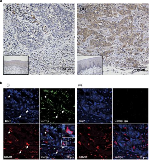 A high expression of GDF15 was detected not only in cancer cells but... | Download Scientific ...