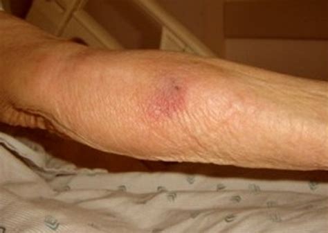 Phlebitis - Pictures, Symptoms, Treatment and Causes