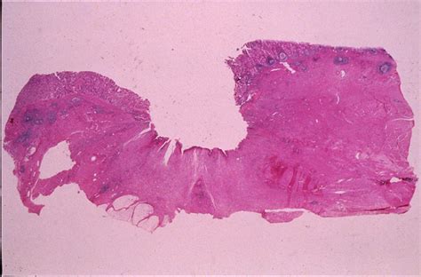 Gastric Ulcer Histology