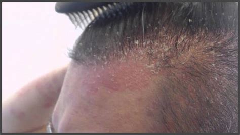 Scalp psoriasis pictures | Psoriasis expert