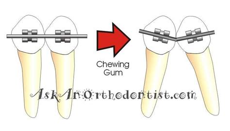 Why you should stay away from sticky foods and gum with braces | Brace ...