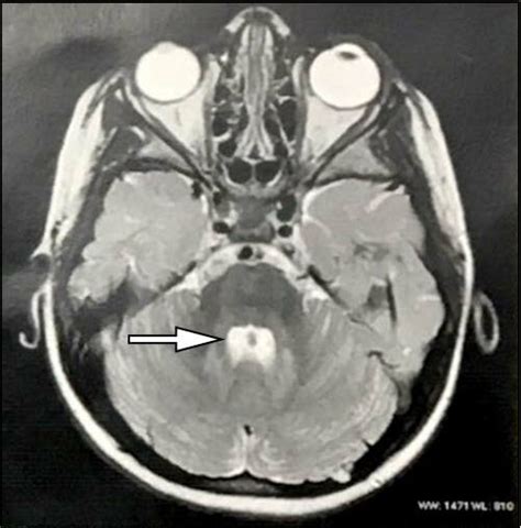 Observe nonspecific hypersignal in the dentate nucleus area on ...