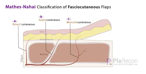 Fasciocutaneous Flap Classifications- Cormack and Lamberty, Mathes and Nahai, Nakajima