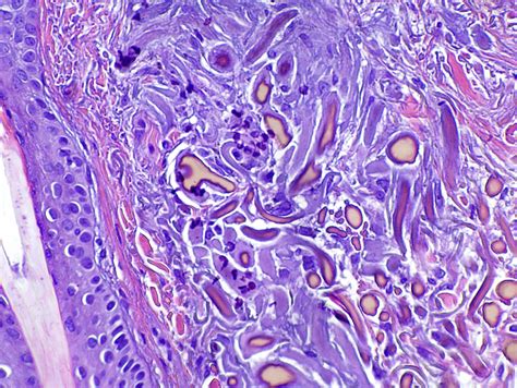 Pathology Outlines - Ochronosis