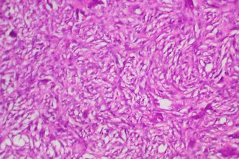 Histiocytoma Histology