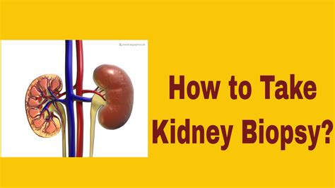 Kidney Cancer Biopsy Procedure - YouTube