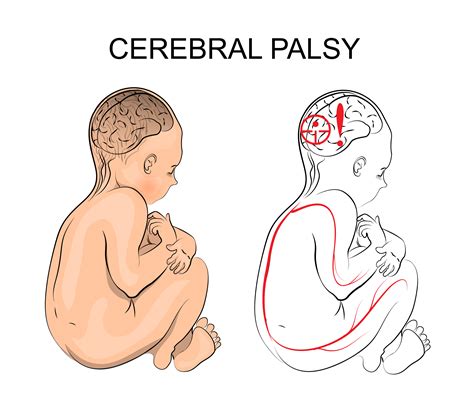 UPG: Cerebral Palsy and Marijuana; Treat Cerebral Palsy With Cannabis!