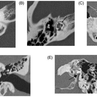 Radiological classifications of otosclerosis on preoperative CT‐scan ...