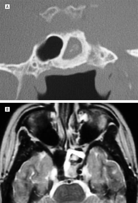 Evaluation and Surgical Management of Isolated Sphenoid Sinus Disease ...