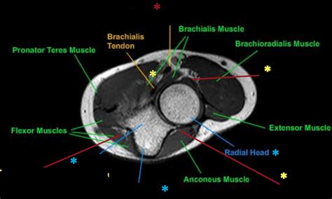 elbow axial MRI 5 Diagram | Quizlet