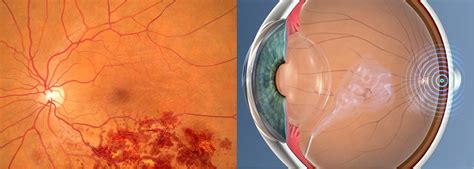 24. Intravitreal injections for retinal vein occlusion - Retina Doctor