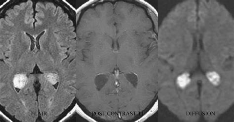 Neuroradiology Cases: Choroid plexus cyst MRI