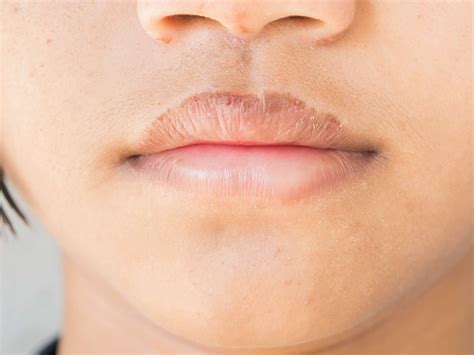 How Do I Get Rid Of Severely Chapped Lips in 2020 | Chapped lips, Sore lips, Chronic chapped lips