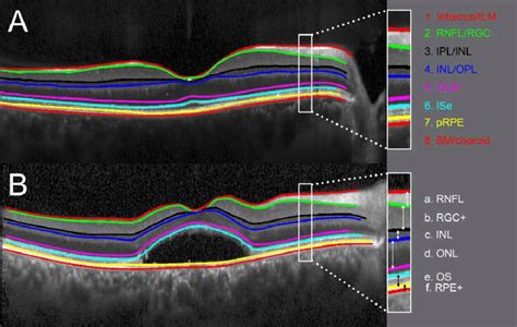 Segmentation of retinal layers. Horizontal SD-OCT from a healthy... | Download Scientific Diagram