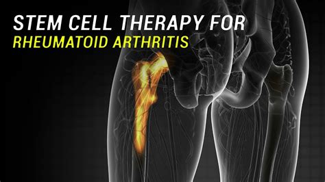 Stem Cell Therapy for Rheumatoid Arthritis - YouTube