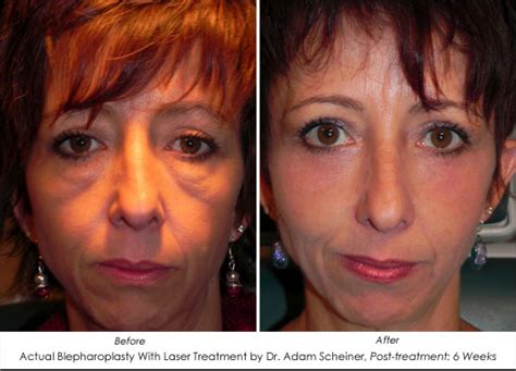 Laser Treatment For Undereye Bags And Festoons - AHB