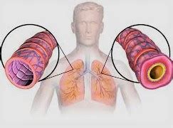 Allergic Asthma Causes Symptoms and their Way of Treatment at home