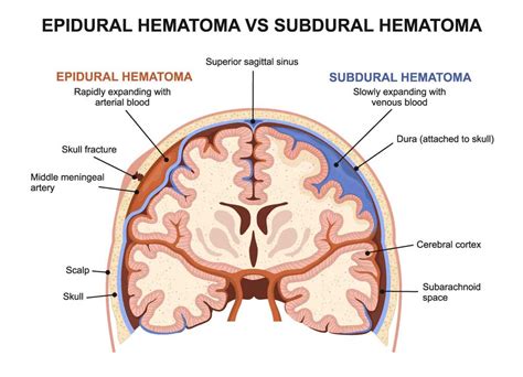 Subdural vs Epidural Hematomas - Diller Law Personal Injury Law