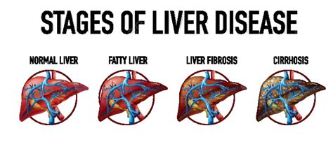 Stages Of Liver Disease Physiological Sciences Health Vector ...