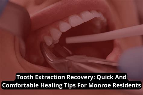 Tooth Extraction Recovery: Quick And Comfortable Healing Tips For Monroe Residents - Apple Dental