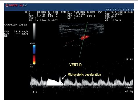 Figure 4 from An Update on Doppler Ultrasound of Vertebral Arteries: Subclavian Steal Syndrome ...