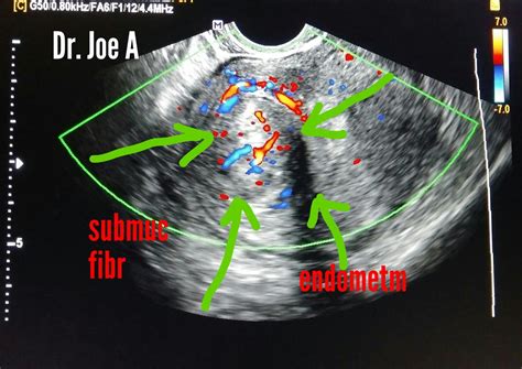 Ultrasound imaging: Submucosal fibroid