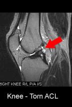 MRI Images - torn ACL and normal ACL