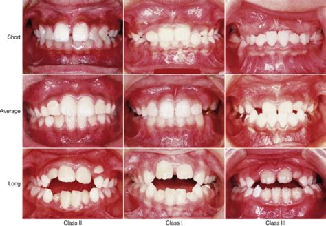 Types And Causes Of Malocclusion - David F. Urich, DDS